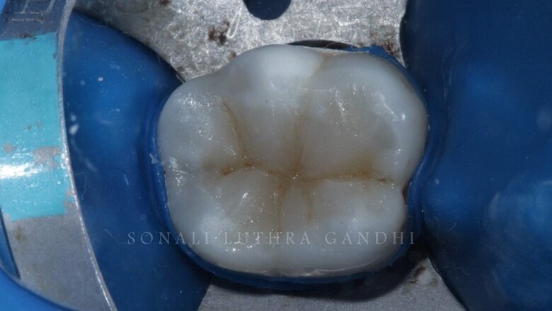 Fig 14: Application Of Tints