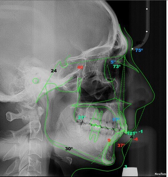 Fig. 27: Steiner cephalometric analysis four years after treatment (image generated using NemoCeph Studio).