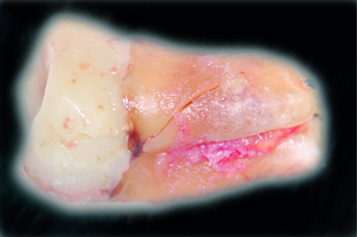 Fig. 14c: Clinical image: Extracted, fractured tooth #47.