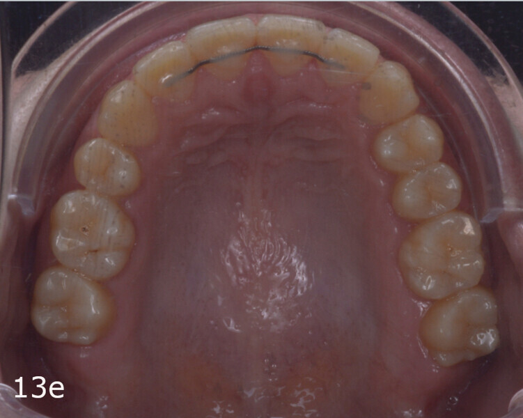 Figs. 13a–f: Final situation. The lack of overjet and overbite and the midlines had been improved and anterior and canine guidance achieved.