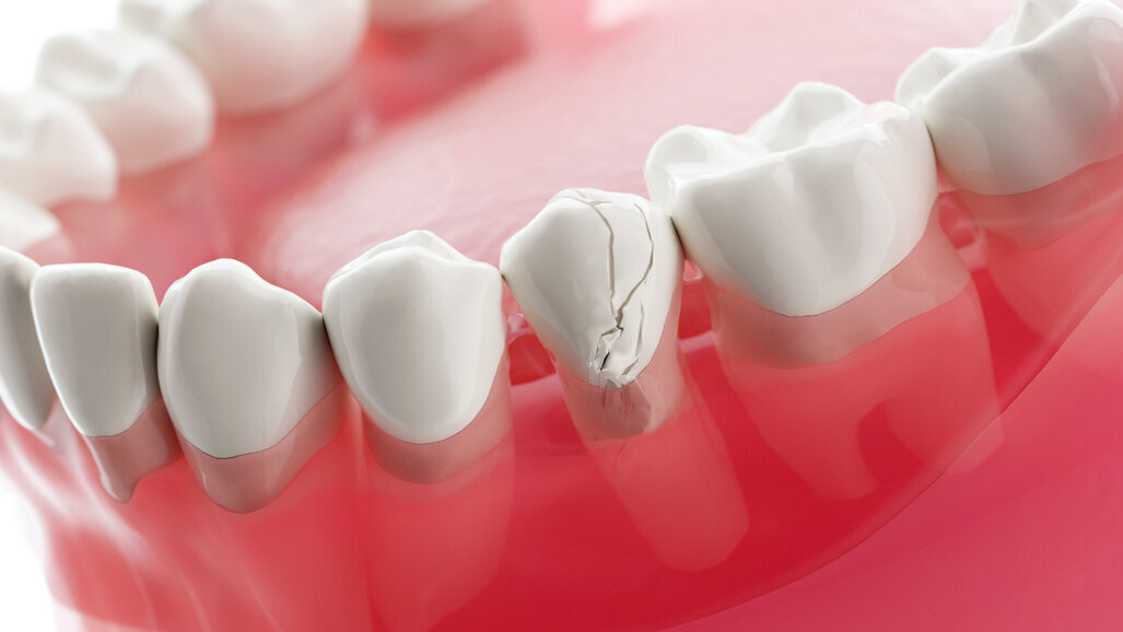 S2k-Leitlinie zur Versorgung dentaler Traumata aktualisiert