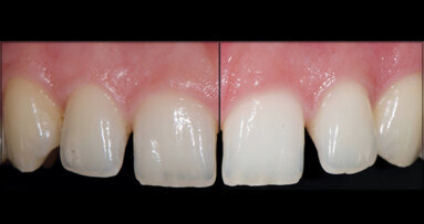 Dokonalost a komfort při bělení