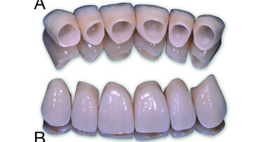 FujiCEM Evolve, un ciment verre ionomère modifié par adjonction de résine