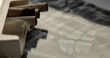 Study links tooth growth patterns to smoking history