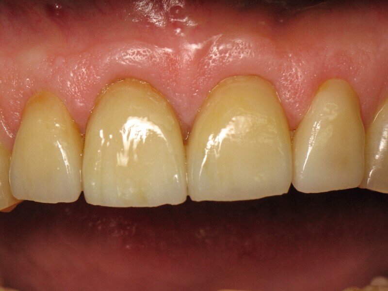 Fig. 2 : Vue rapprochée de la situation finale.