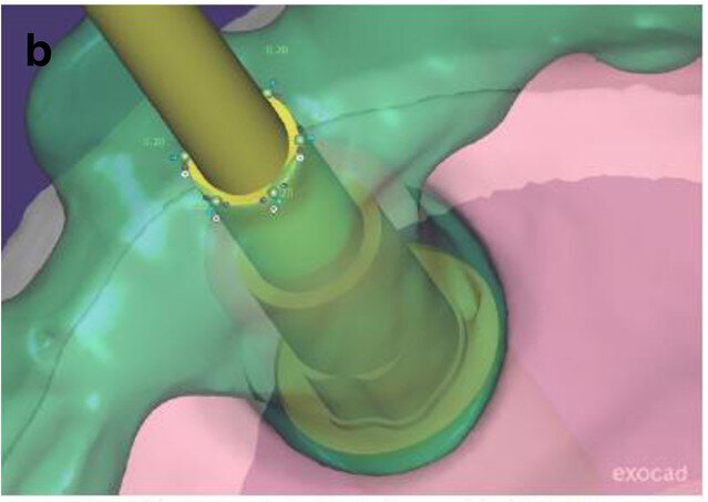 Fig. 6b: Occlusal view showing CAD of the provisional FDP framework (a) and close-up views from the interface between the CAD framework and the prefabricated titanium abutments (b & c).