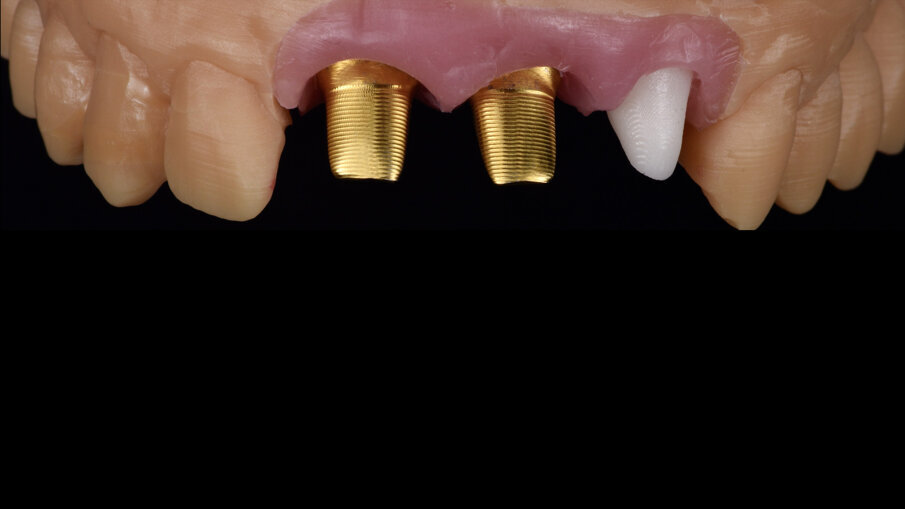 Fig. 5_Modello realizzato da impronta intraorale master attraverso la stampa 3D, si può osservare i due t-base customizzati per elementi su impianto.