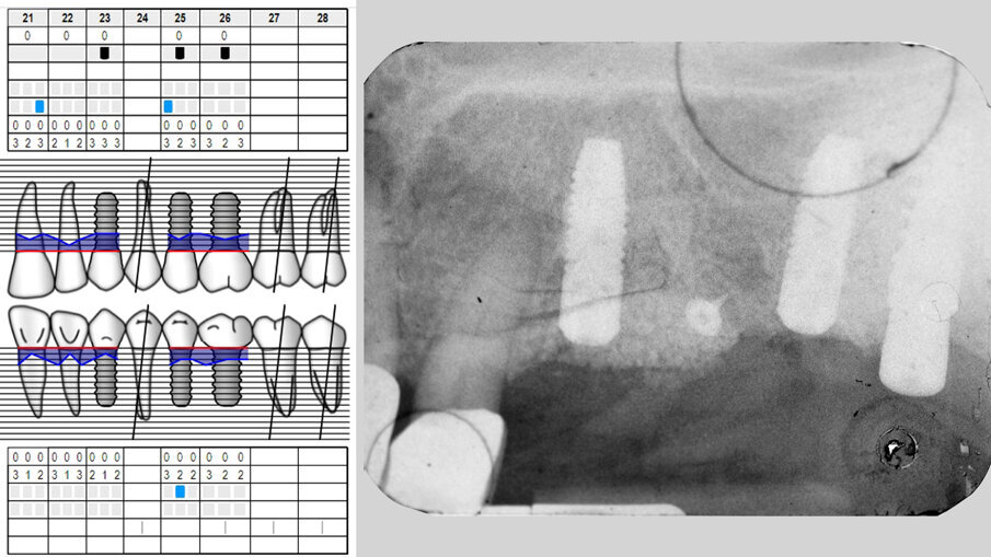 Fig. 13 - Viti di guarigione posizionate sulle teste degli impianti.