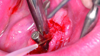 The TwinLight approach to peri- implantitis