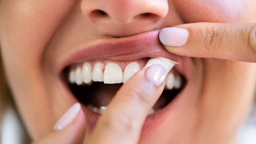 Snus linked to gingival damage but not periodontitis, review finds