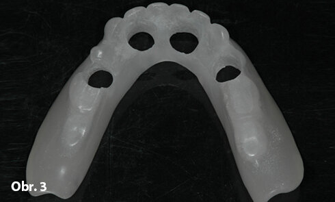 Duplikát vyhovující náhrady slouží jako individuální lžíce. Pro umožnění otisku pilířů byly vypreparovány otvory patřičných rozměrů.