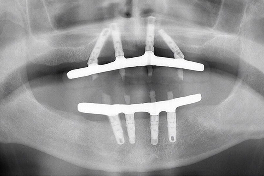 Fig. 22. Rx Pre-operatoria, Prótesis híbrida inmediata con 5 años de evolución y Rx Control a los 5 años.