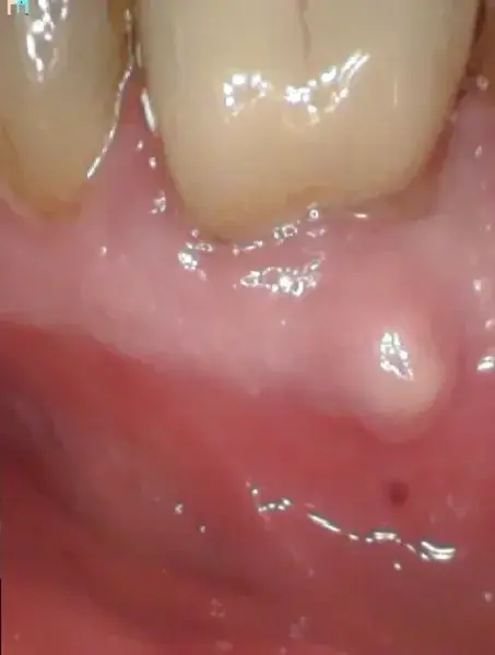 Фиг. 8б Предоперативна рентгенография, на която се вижда фистулата, насочена към коронарната част на кореновия канал.