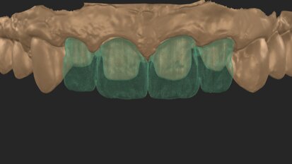 A smooth path towards beautiful smiles: Micro-layering with CERABIEN MiLai