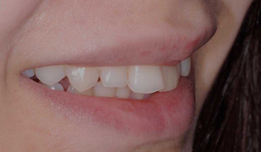 Fig. 19: Smile right side view before treatment.
