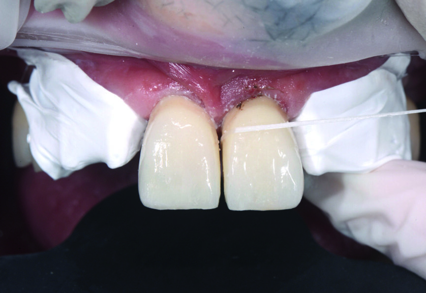 Fig. 11 : Élimination de l’excès de ciment interproximal des incisives centrales.