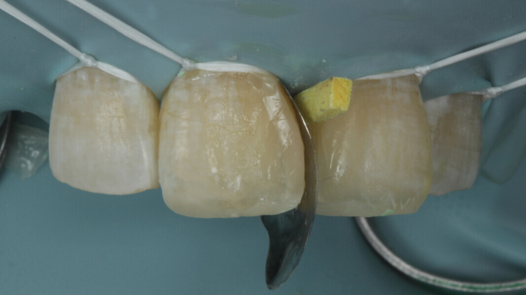 Fig 12. The sectional matrix for posterior teeth was used in a vertical direction and stabilized with wedge.
