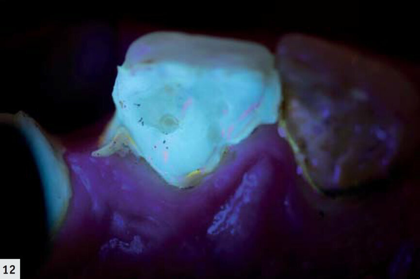 Figs. 11–12 : Bridge adhésif détaché. La fluorescence rouge émise par les porphyrines, les produits métaboliques des bactéries buccales, démontre la présence d’un biofilm mature. 