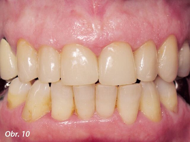 Keramické korunky nacementované na Futurabond DC a Bifix QM (VOCO)