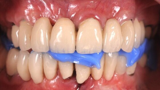 Restaurations définitives pour un nouveau sourire