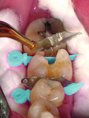 Remove plate from WedgeGuard, wedge remains