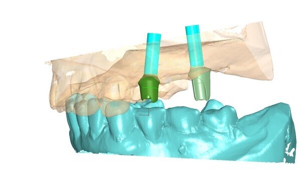 Protesi parziale fissa supportata da impianti nella riabilitazione di edentulie parziali multiple. Il posizionamento implantare “protesicamente guidato”.