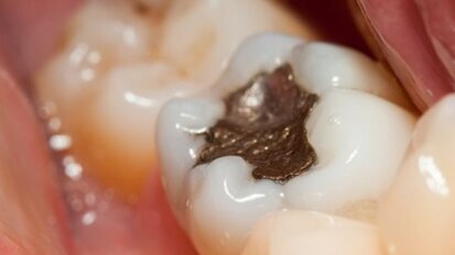 US regulators back down on dental amalgam issue
