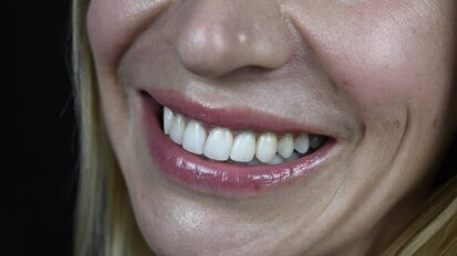 Treatment of a patient with a congenitally missing lateral incisor using aligners: A case report