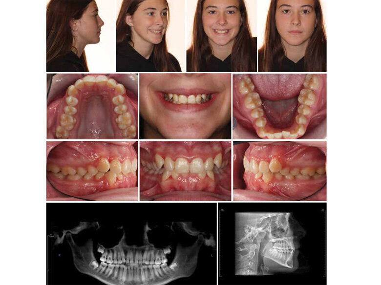 Fig. 5: Final recods. (Photos: Michael J. Mayhew, DDS, MS, MS, & Nicole R. Scheffler, DDS, MS)