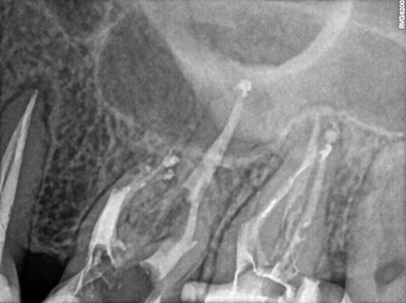 Fig. 23: Post-op radiograph of both molars.