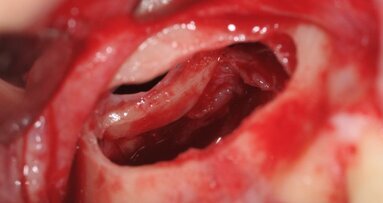 Rialzo di seno mascellare mediante utilizzo di osso eterologo corticomidollare collagenato