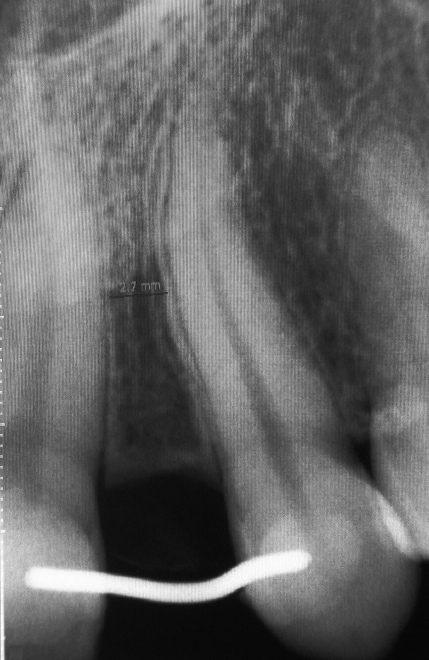 Fig. 2 : Radiographie périapicale du site de l’agénésie de l’incisive latérale gauche maxillaire. L’espace entre les racines des dents 21 et 23 est toujours problématique après le traitement orthodontique. 