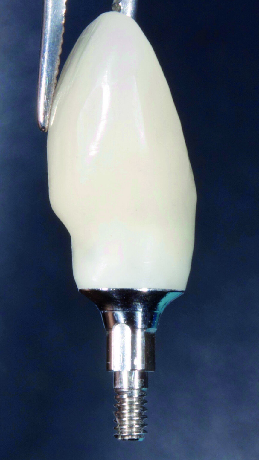 Fig. 9: Temporary crown was installed to support the formation of soft tissues.