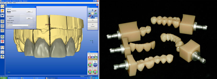 Figs 13A-B: CAD/CAM based fabrication of long-term temporaries from high performance PMMA