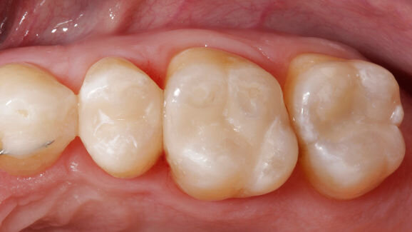 Nano-hybrid composites rank high in clinical study