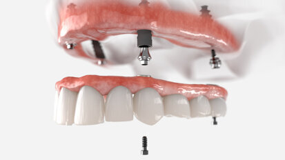 Preferences for fixed restorations and resulting impact on the US and European overdenture markets