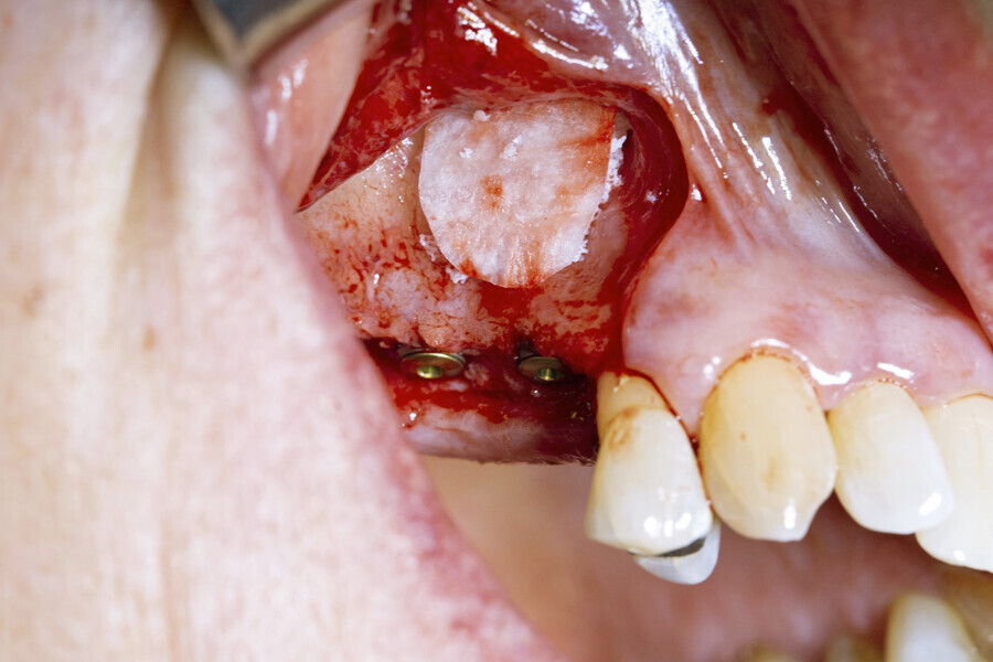 Fig. 9: Symbios Collagen Membrane SR trimmed to shape to complete the guided bone regeneration procedure.