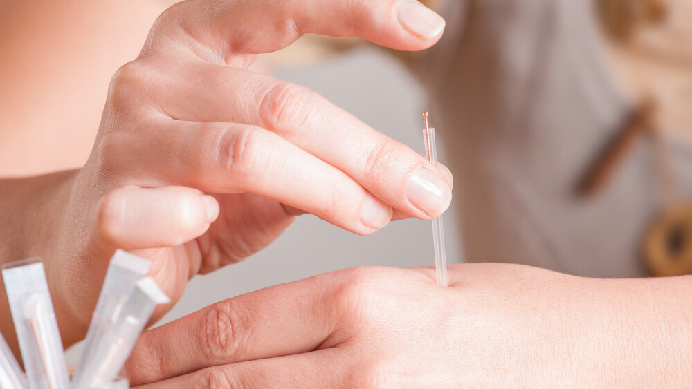 Acupuncture: Probing its way into dentistry—Part I