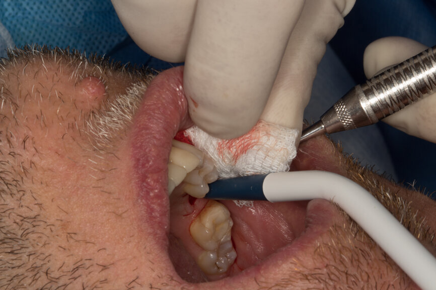 Ryc. 4-5_Odsłonięcie płata śluzówkowo-okostnowego.
