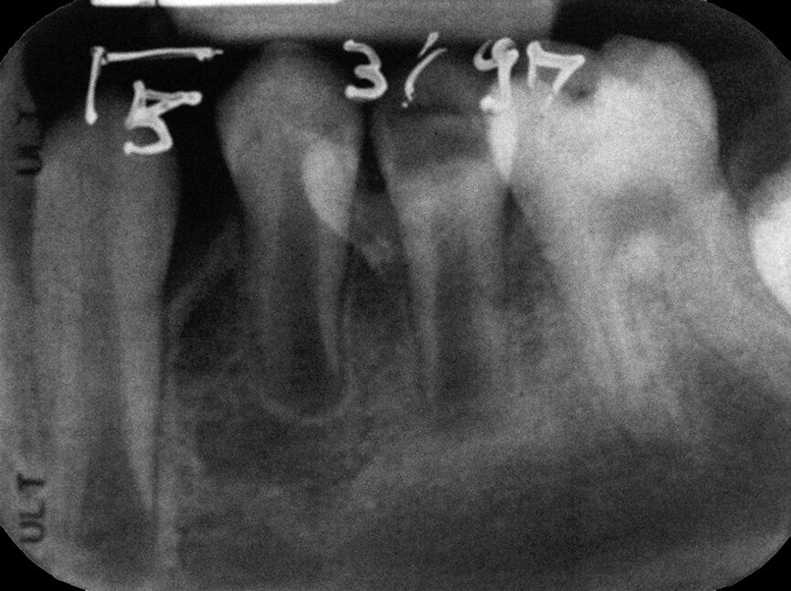 Case 1: Male (born 5 June 1987): Tooth 35
Fig. 3a: 18 March 1997 ante pulpotomy.