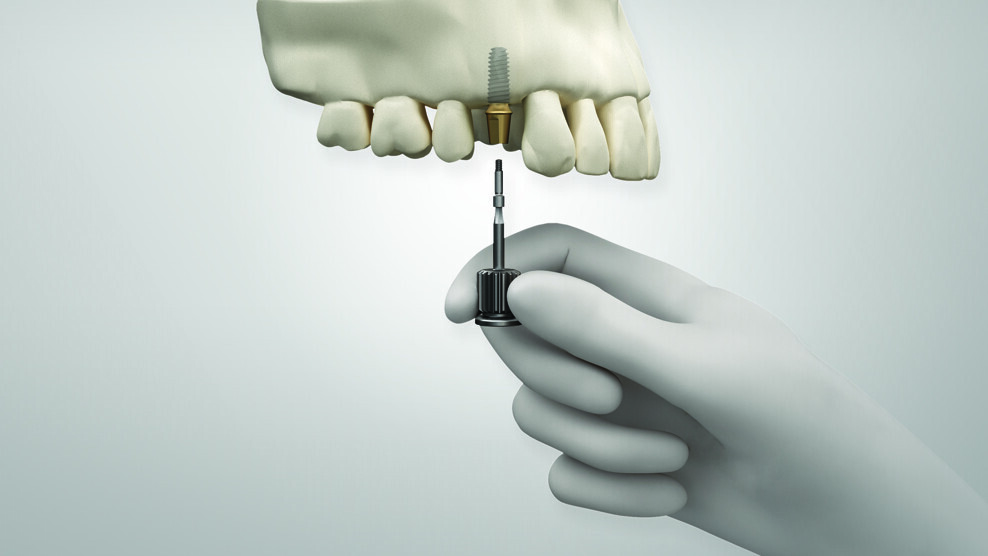 The KS implant system offers single-handed use. (Image: Osstem Implant)