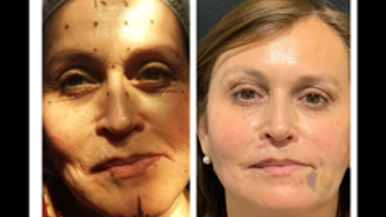 Foto 8. Comparación de inicio de tratamiento(izquierda) y a los 7 meses 15 días de post tratamiento (derecha) con hilos y efecto de toxina botulínica (segunda aplicación). Aún se observa equimosis de tratamiento de hilos revitalizantes peribucales. Nótese el mejoramiento general y aspecto de la mirada de paciente. Ella y su familia están felices con la mejora lograda.
