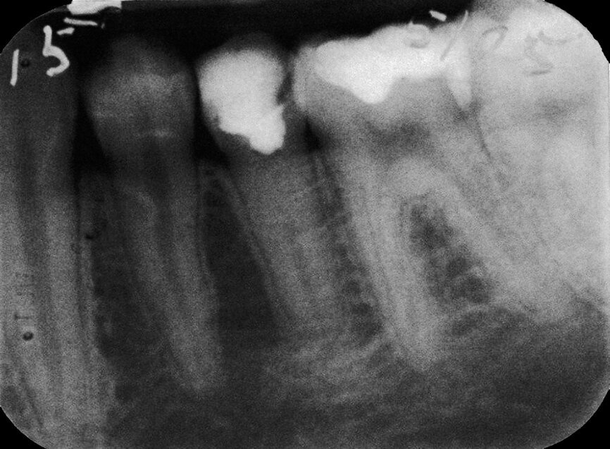 Case 1: Male (born 5 June 1987): Tooth 35
Fig. 3c: 6 May 2005 status