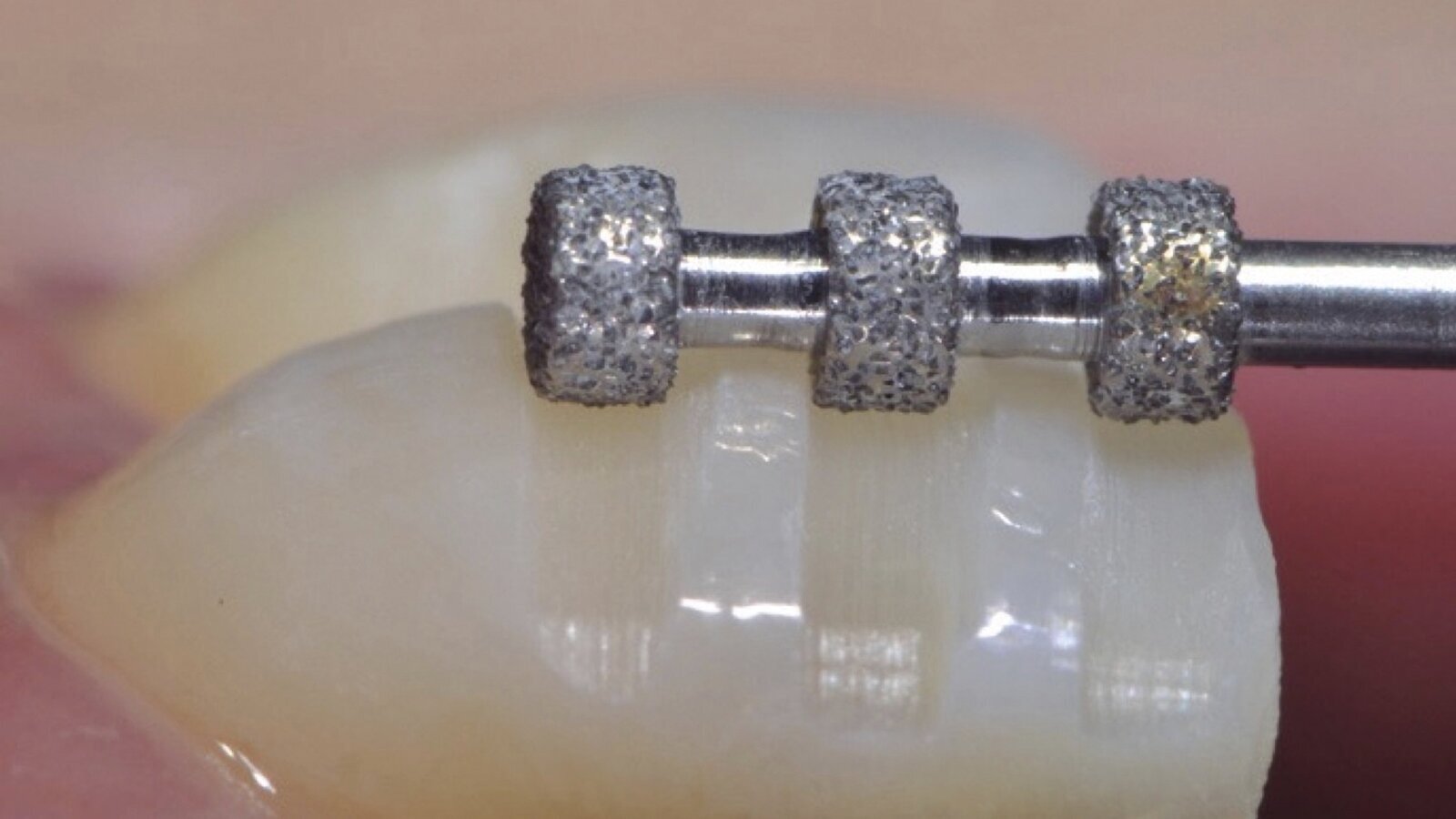 Estética y blanqueamiento dental en la era digital  (Capítulo 14)