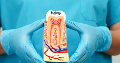 Therapeutic pulpotomy emerging as an alternative to root canal therapy