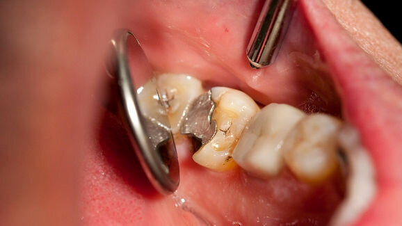 La Commission européenne étudie les aspects environnementaux du mercure dans les amalgames dentaires