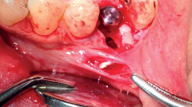 Ruolo del collare in zirconio nella gestione della perimplantite: case report