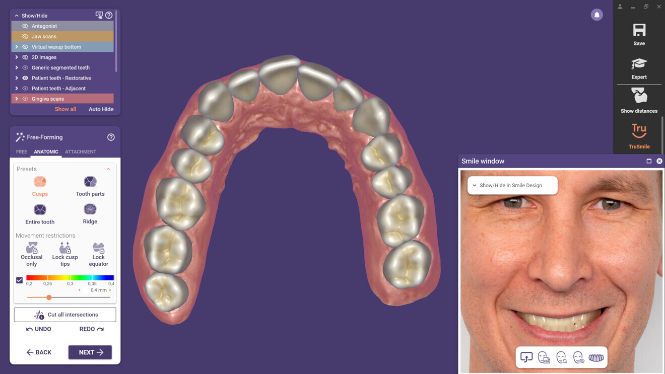 With the Smile Creator module, users can now design virtual gingivae for more realistic outcomes and create smiles based on patients’ natural teeth.