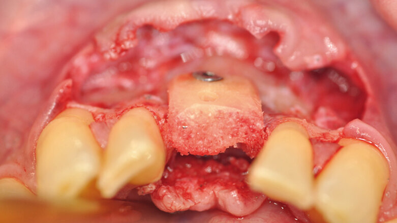 Přežití alogenních kortikospongiózních kostních bloků
