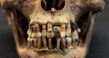 La dentition de la dépouille d'Anne d'Alègre livre ses secrets grâce au Cone Beam